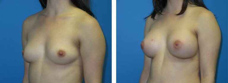 Breast augmentation case 41_2