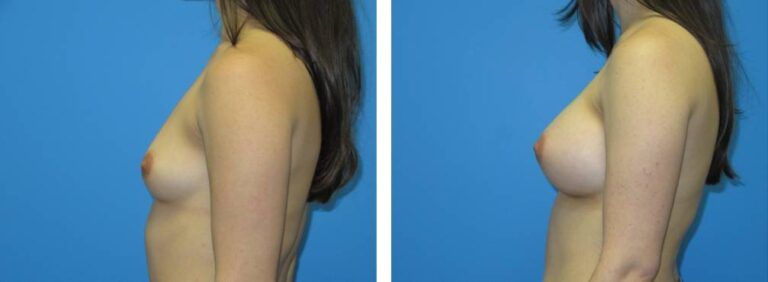 Breast augmentation case 41_3