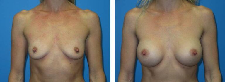 Breast augmentation case 42_1