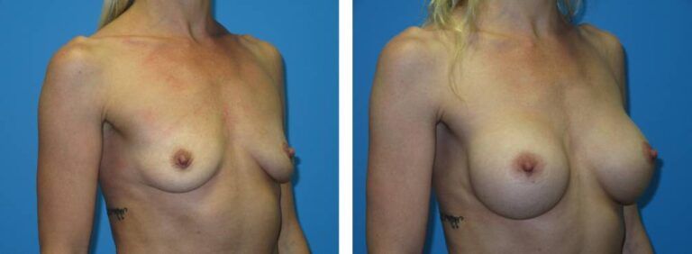 Breast augmentation case 42_2