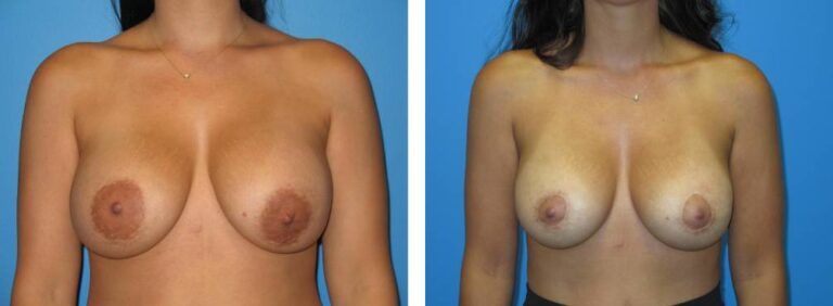Breast augmentation case 44_1