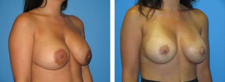 Breast augmentation case 44_2