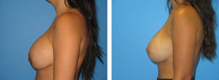 Breast augmentation case 44_3