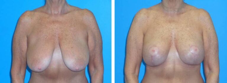 Breast augmentation case 45_1