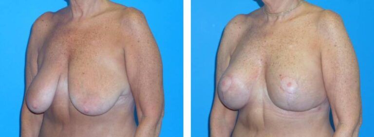Breast augmentation case 45_2