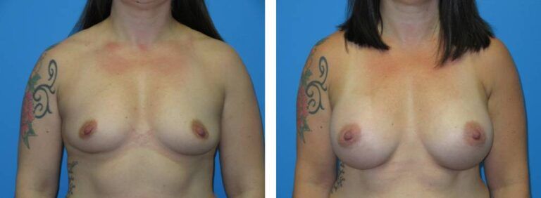 Breast augmentation case 46_1