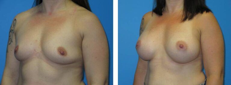 Breast augmentation case 46_2