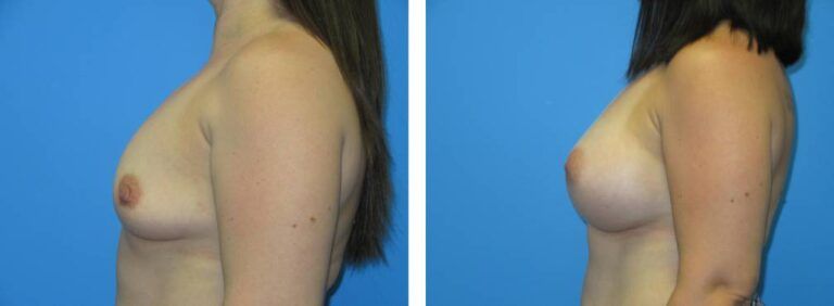 Breast augmentation case 46_3