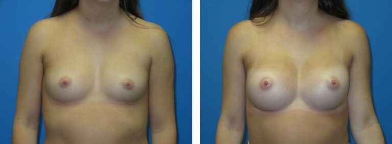 Breast augmentation case 47_1
