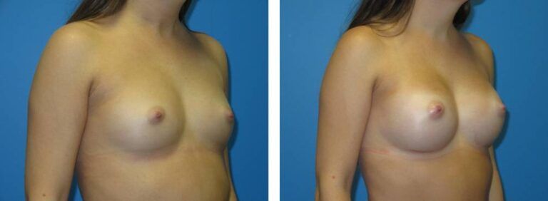 Breast augmentation case 47_2