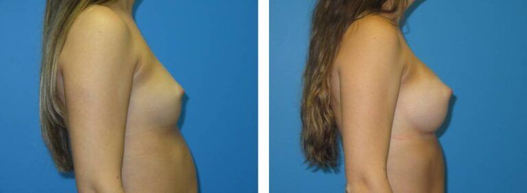 Breast augmentation case 47_3