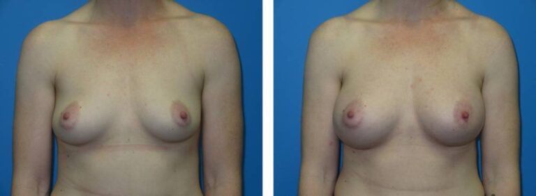Breast augmentation case 48_1