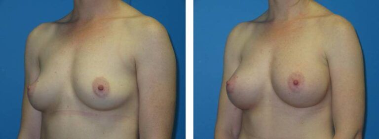 Breast augmentation case 48_2