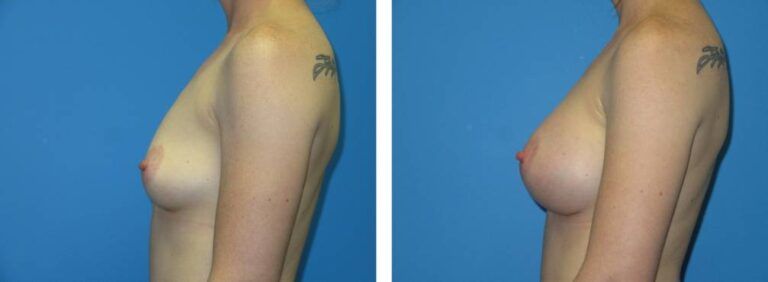 Breast augmentation case 48_3