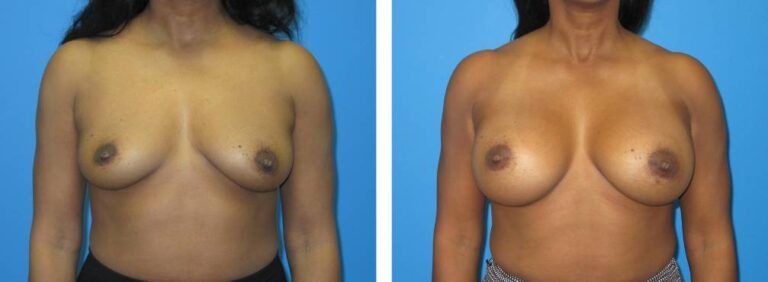 Breast augmentation case 49_1