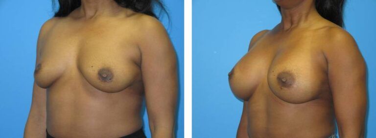 Breast augmentation case 49_2