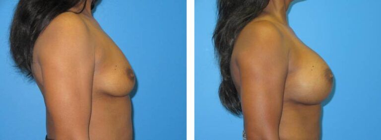Breast augmentation case 49_3