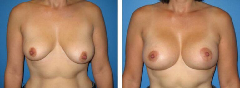 Breast augmentation case 5