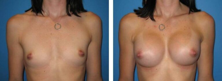 Breast augmentation case 6