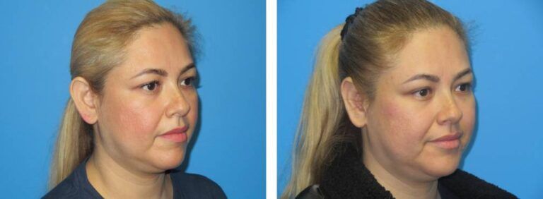 Otoplasty Case BA 7_2