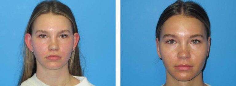 Otoplasty Case BA 8_1