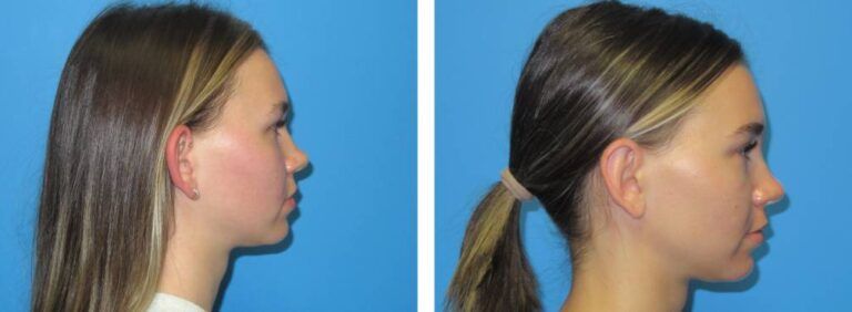 Otoplasty Case BA 8_2
