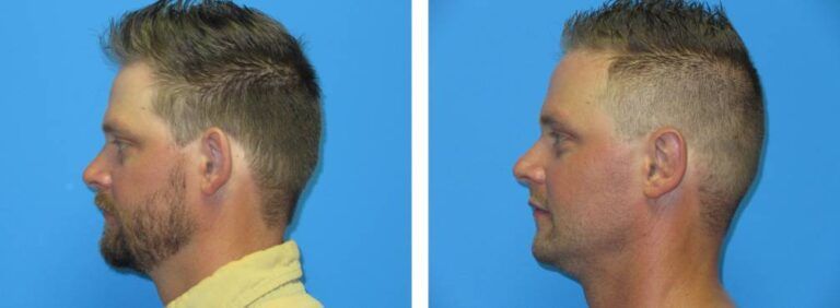 Otoplasty Case BA 9_2