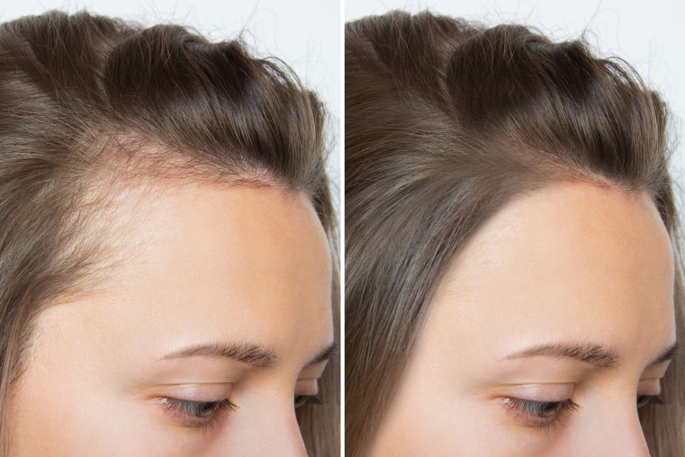 Cropped before and after head shot of a young woman with bald patches on her forehead