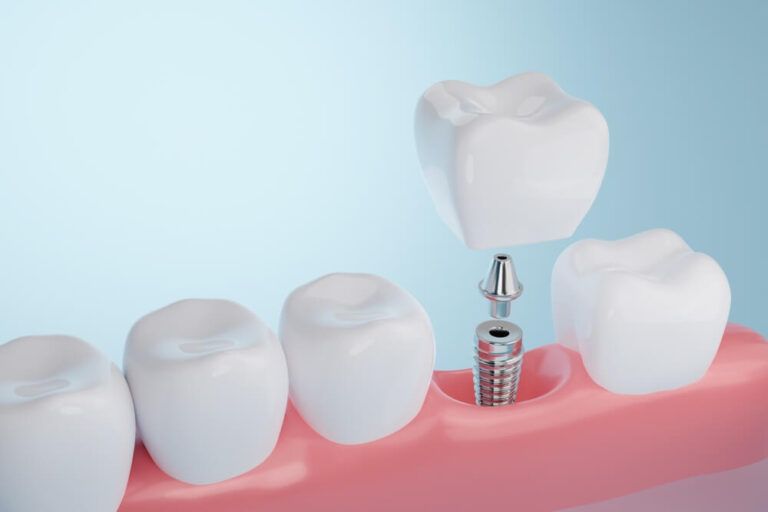 Healthy gums and Dental implant on blue background. 3D rendering
