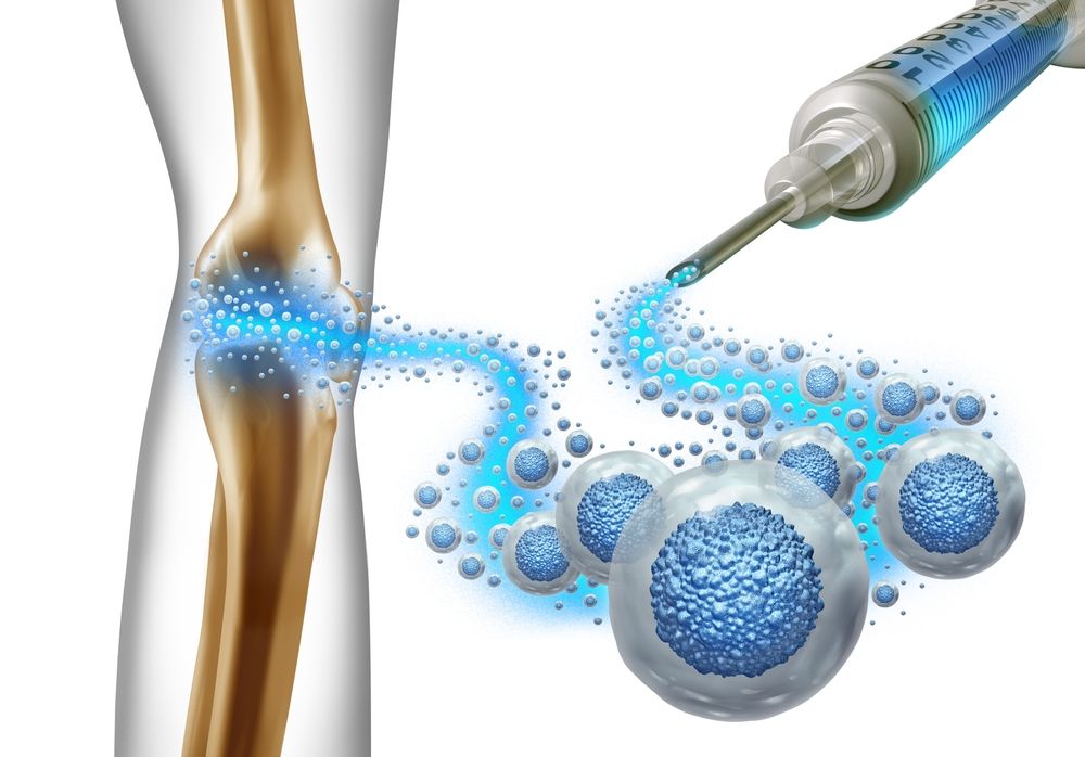 Injecting mesenchymal stem cells (MSCs) into the knee is a regenerative medicine treatment being explored for knee osteoarthritis (OA) to potentially reduce pain, improve function, and regenerate cartilage