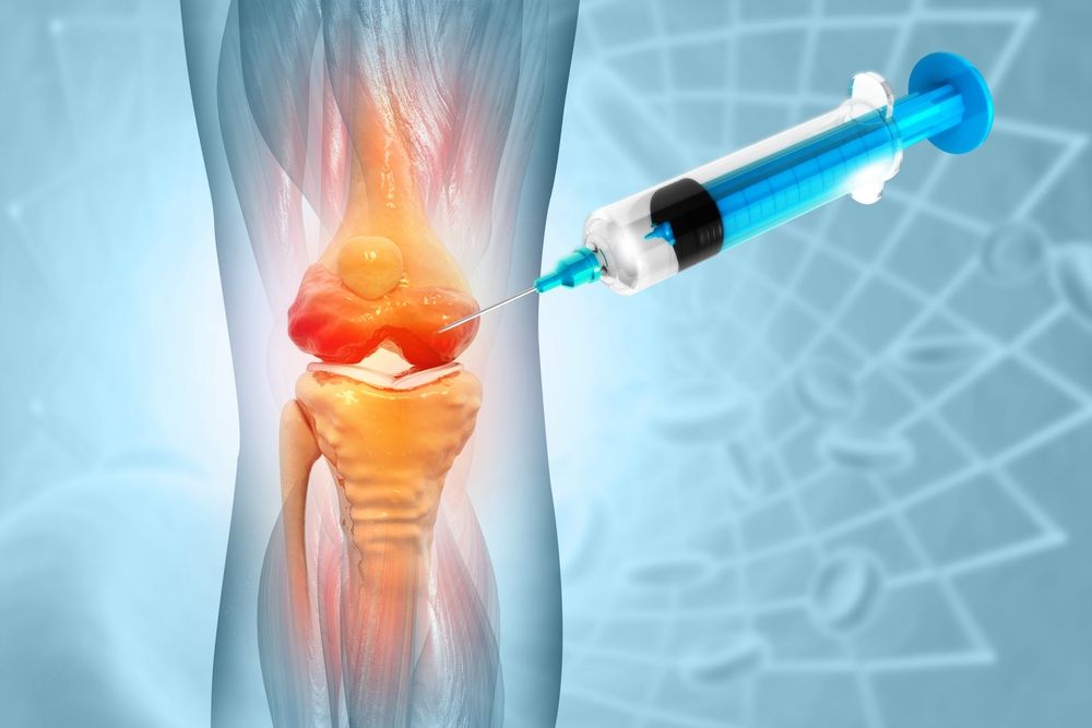 Knee injections for osteoarthritis typically involve injecting corticosteroids for anti-inflammatory effects, hyaluronic acid for joint lubrication, or platelet-rich plasma (PRP) to aid in tissue repair