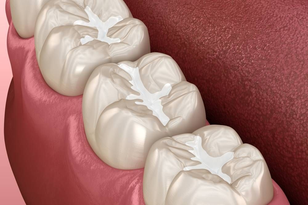 Dental Sealants