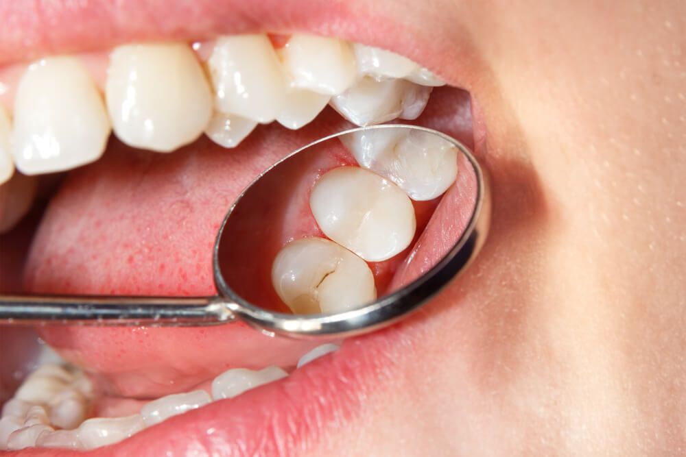 Tooth-Colored Fillings