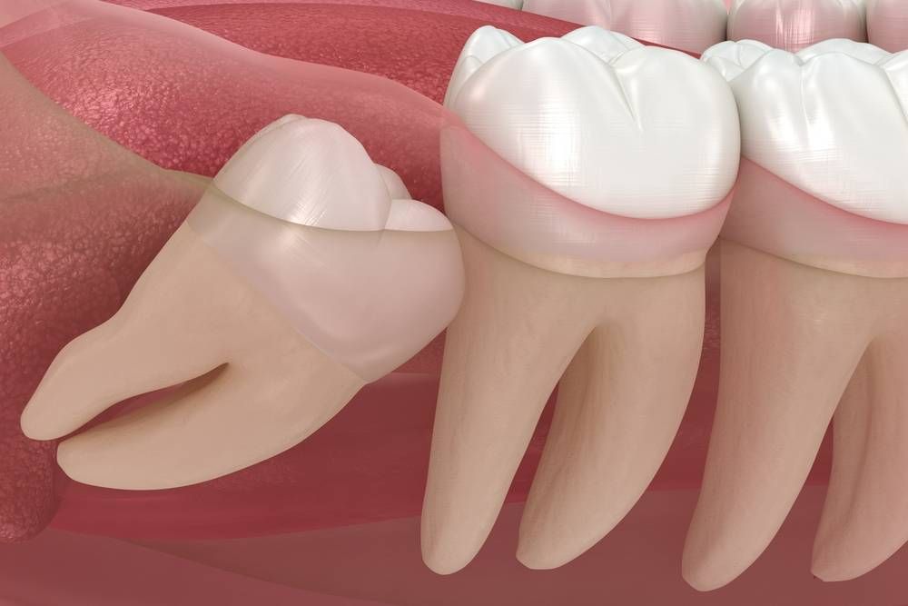 Wisdom Teeth