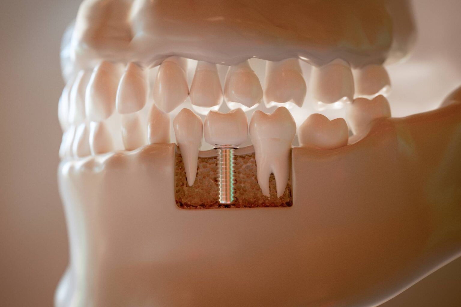 Why dental implants may be right