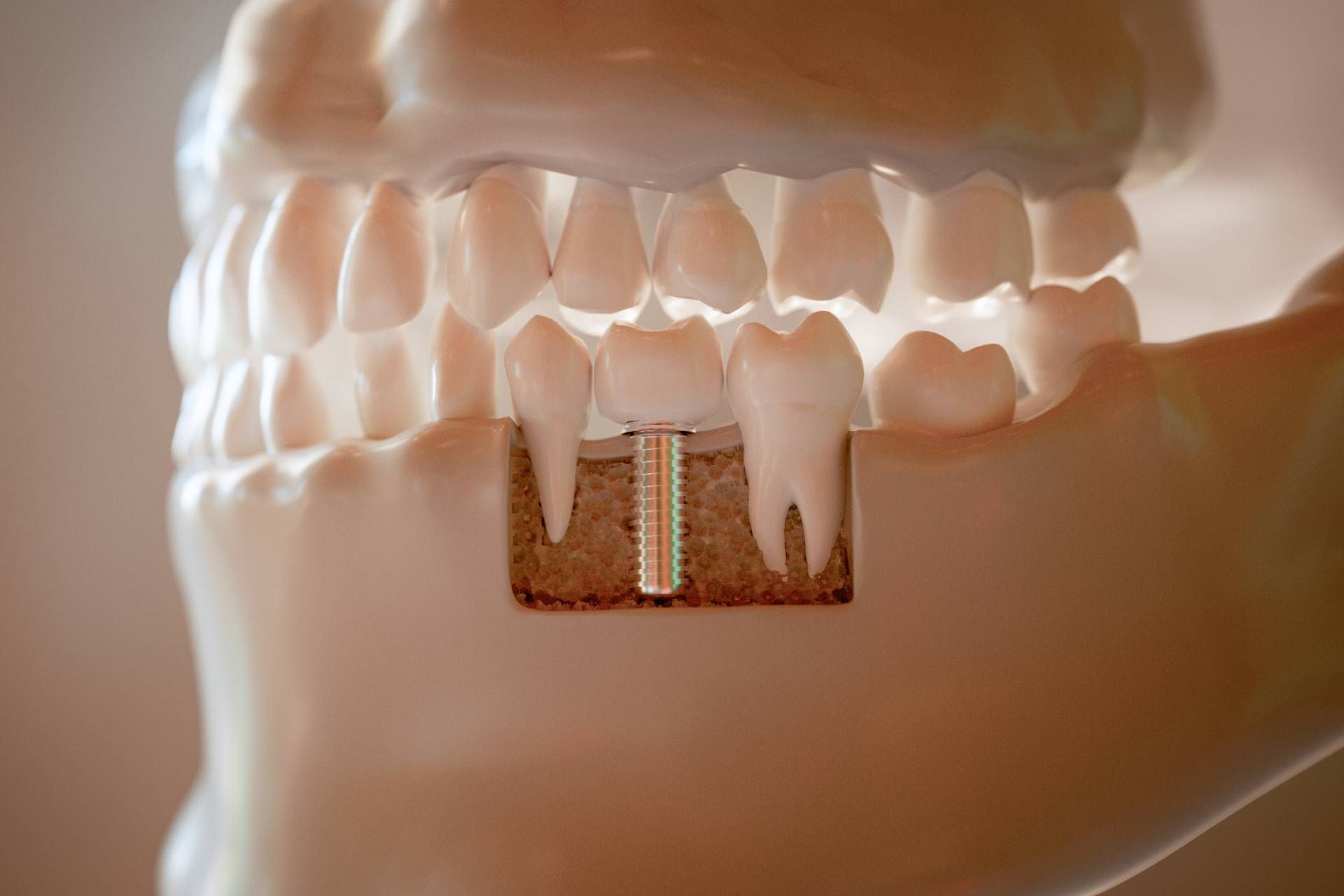 Why dental implants may be right