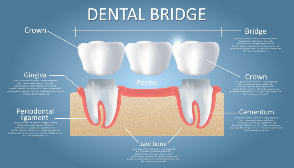 An illustration of the anatomy of a Dental Bridge