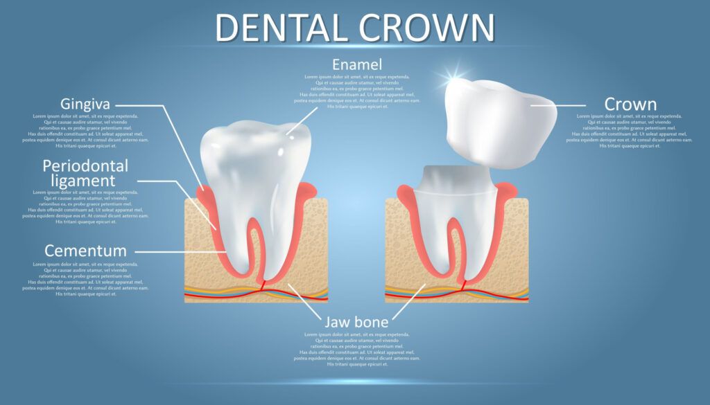 An illustration of the anatomy of a Dental Crown