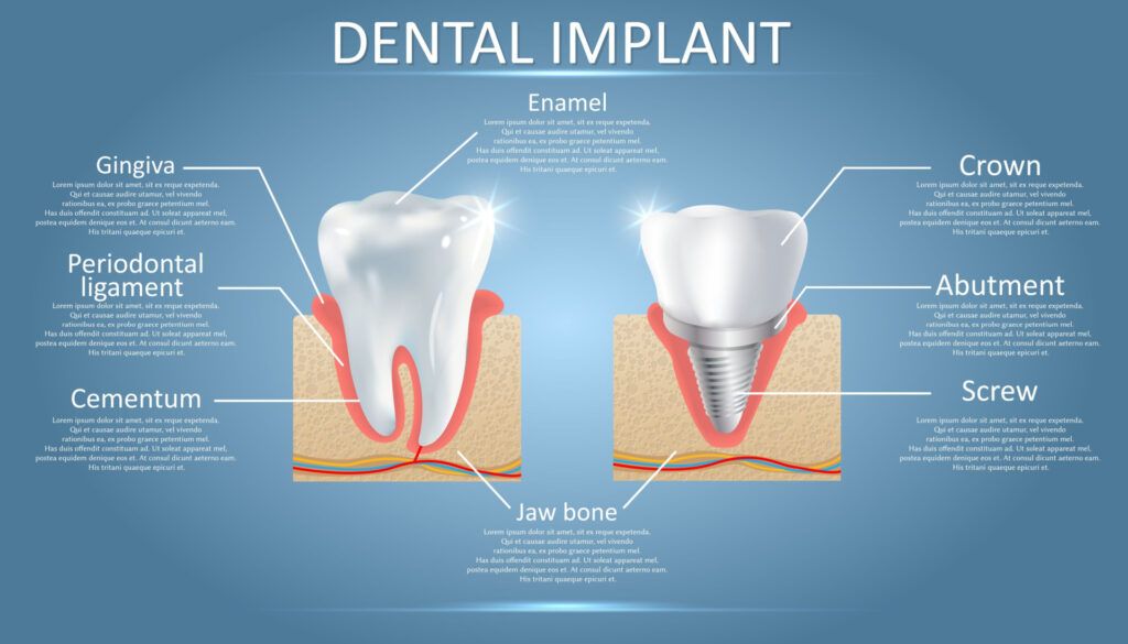 An illustration of a Dental Implant 