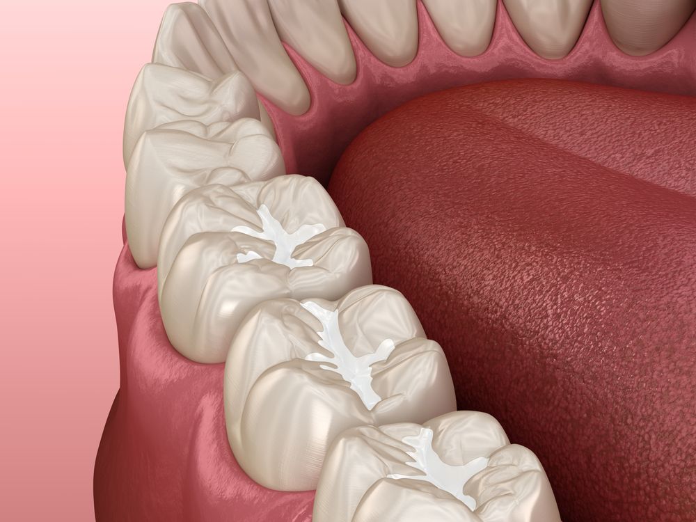 An example of composite fillings in teeth