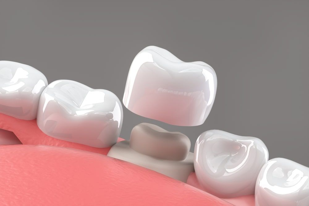 Preparated molar tooth for dental crown placement