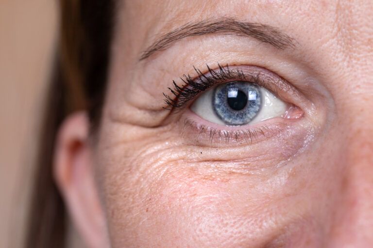 Understanding Blepharoplasty