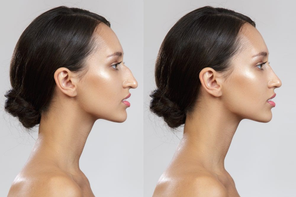 Rhinoplasty