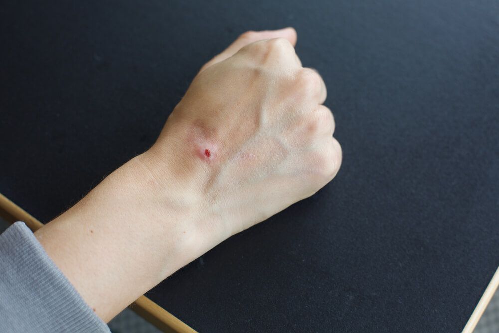 Bleeding non healing wound on hand