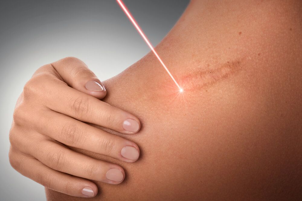 Female shoulder and laser beam during treatment