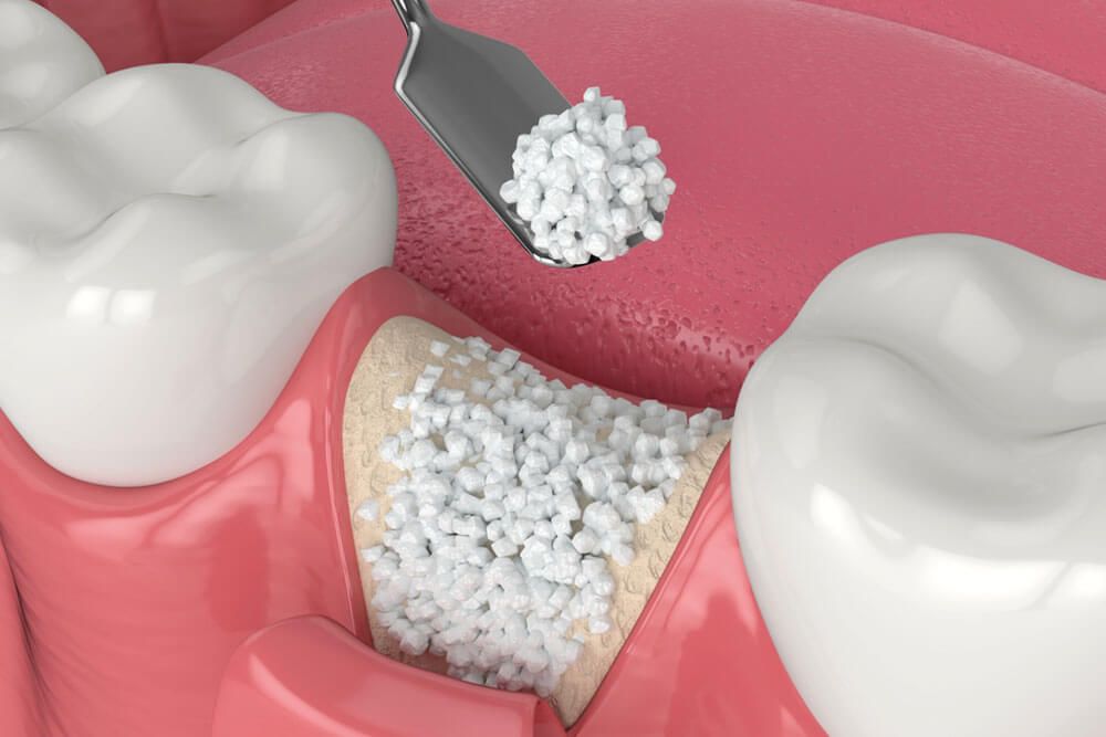3D render of dental bone grafting