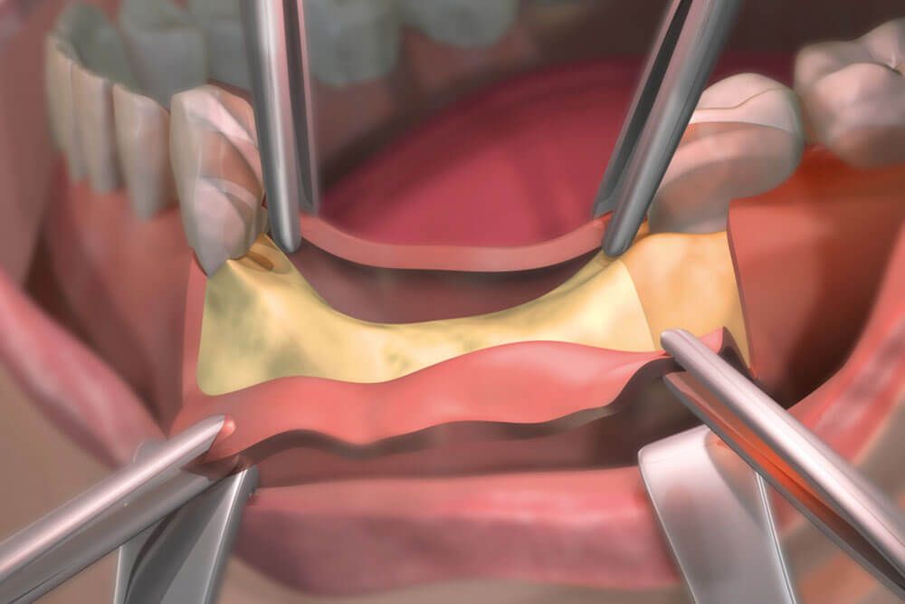 Bone regeneration. Step of opening gums. 3D illustration.