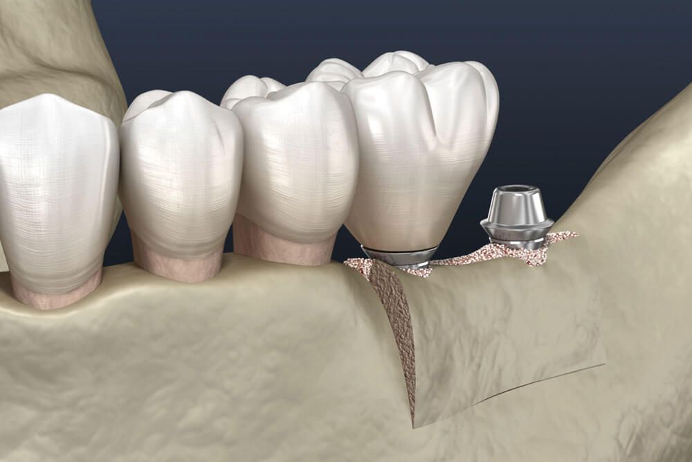 Dental surgery, 3D illustration