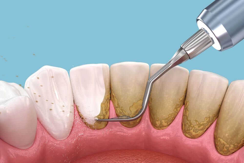 Medically accurate 3D illustration of human teeth treatment