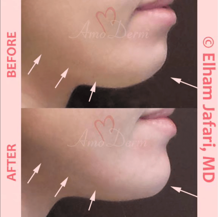 Nonsurgical chin augmentation and Jawline Contouring